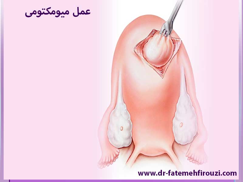 نحوه انجام میومکتومی 