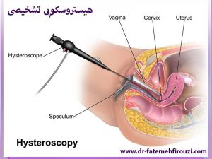 ابزار تشخیصی هیستروسکوپی