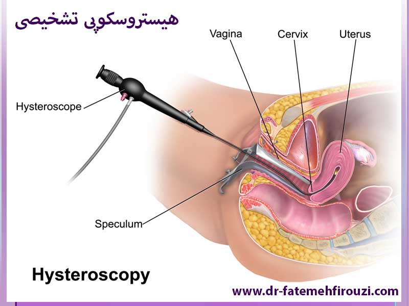 هیستروسکوپی-تشخیصی-در-کرج