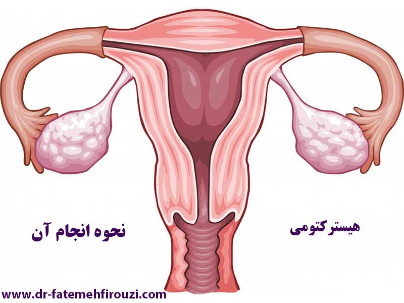 عوارض عمل هیسترکتومی