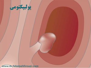 درمان پولیپکتومی