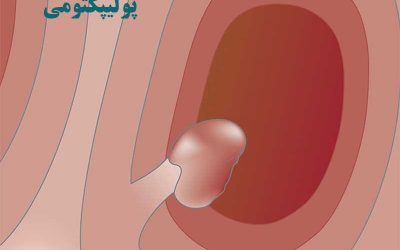 جراحی پولیپکتومی رحم چیست؟