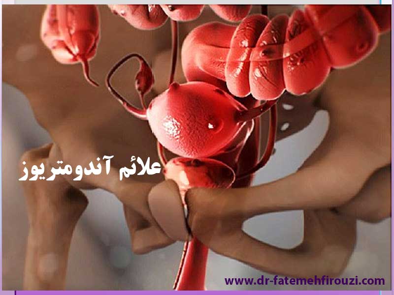 متخصص-زنان-برای-درمان-آندومتریوز-در-کرج