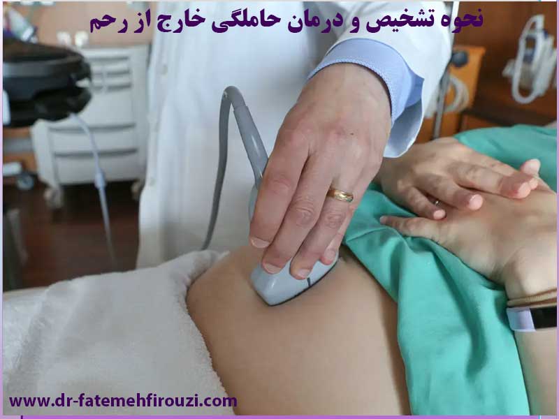 بارداری خارج از رحم