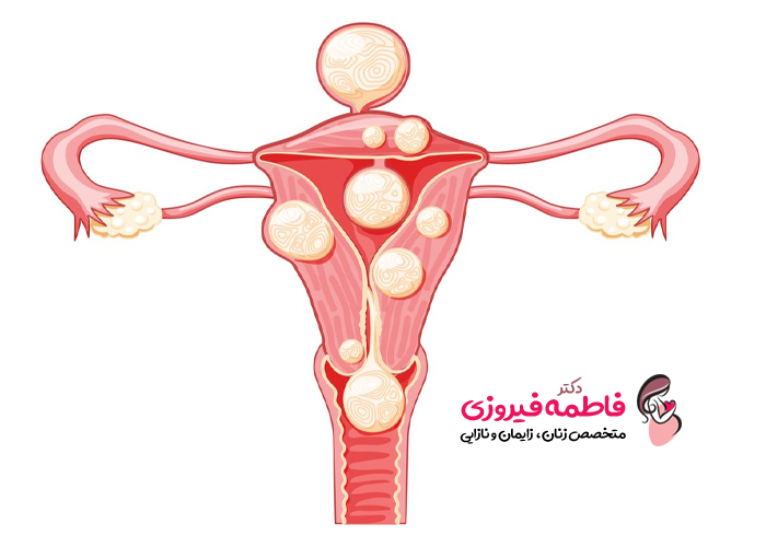 علل مهم ایجاد فیبروم رحم