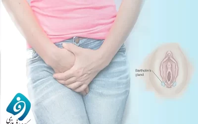 کیست بارتولن چیست و چگونه درمان می شود؟