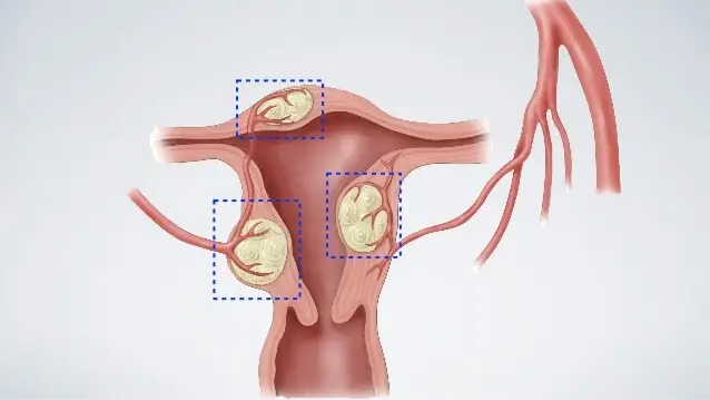 علائم فیبروم رحم