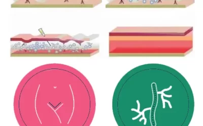 نتایج کربوکسی تراپی واژن چقدر طول می‌کشد ؟