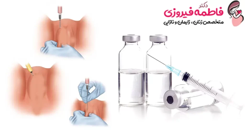 تزریق ژل به واژن