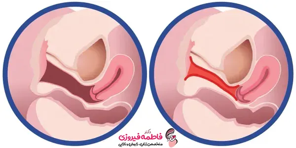 جراحی واژینوپلاستی