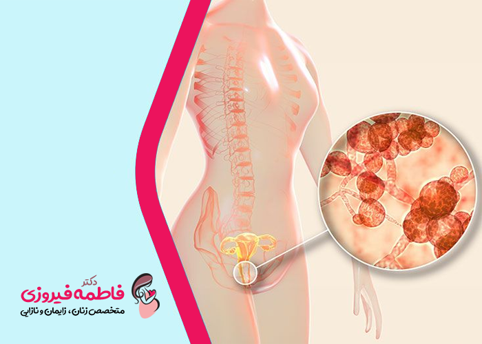 علائم عفونت واژن