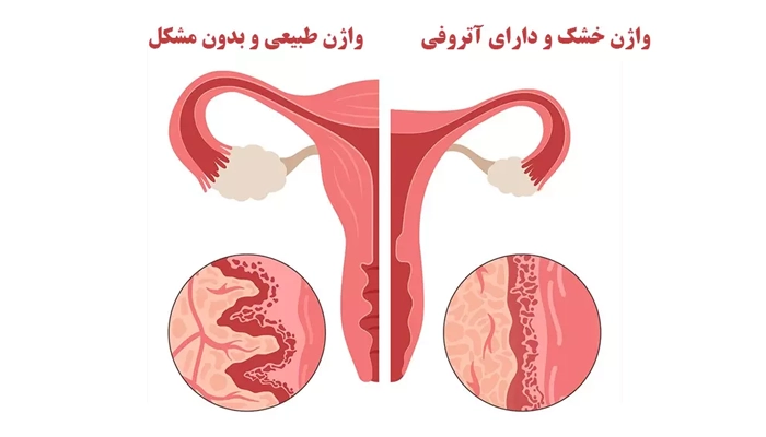 خشکی واژن